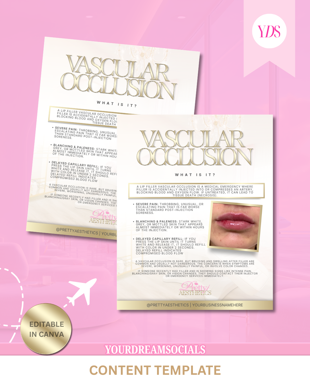 Vascular occlusion template